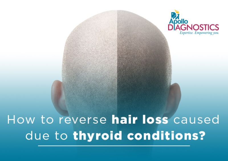 How To Reverse Hair Loss Caused Due To Thyroid Conditions